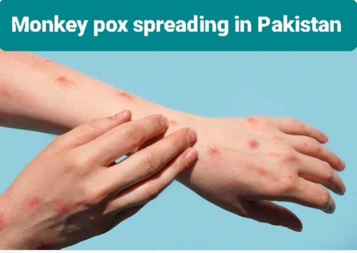 Monkeypox Virus Spreading in Pakistan What are precautions and safety Measurements